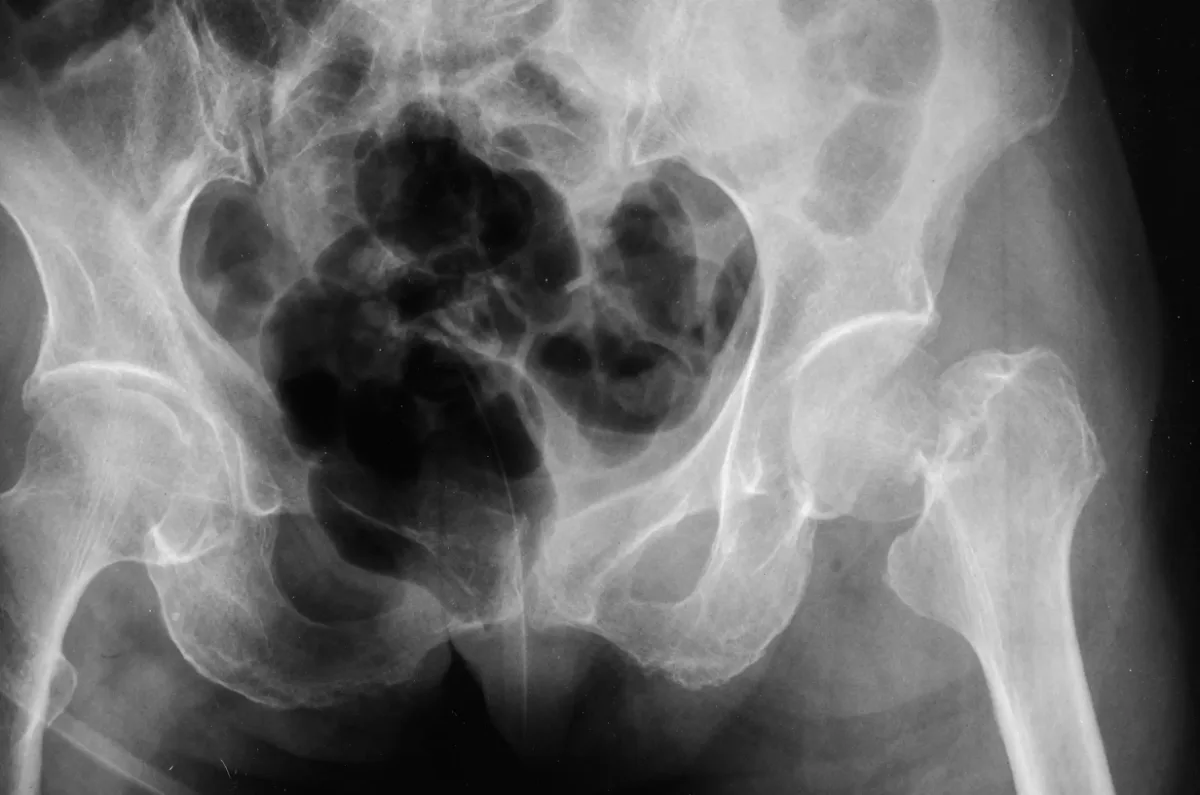 Radiografía de pelvis que muestra la articulación de la cadera