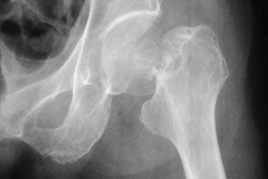 Radiografía de la articulación de la cadera y la parte superior del fémur