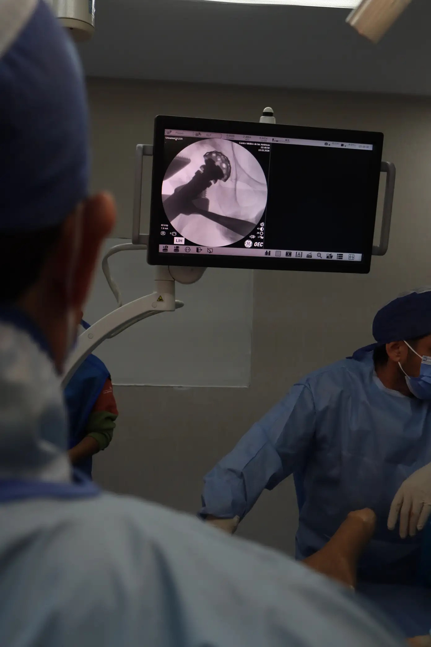 Equipo quirúrgico durante una cirugía de prótesis de cadera con control de imagen en el monitor
