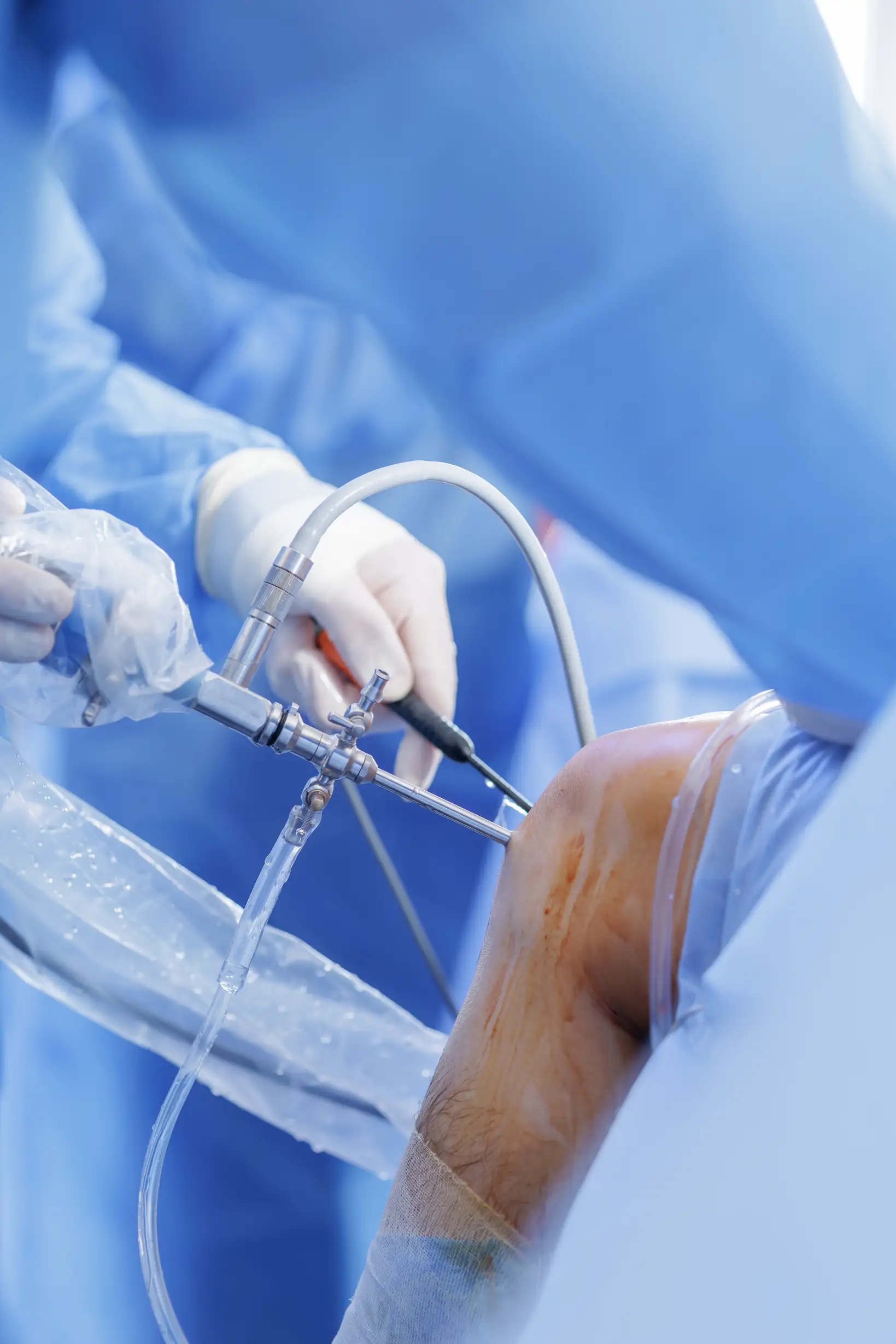 Rodilla siendo operada a través de un procedimiento el cual es artroscopia